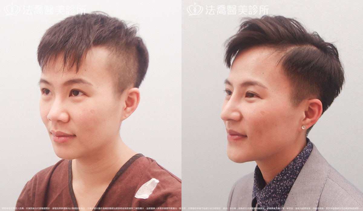 goretex隆鼻,法喬醫美診所,邱浚彥