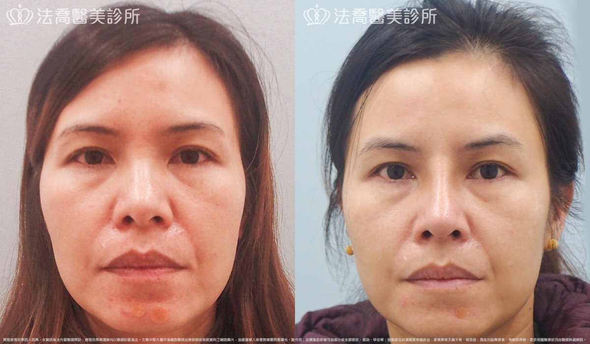 goretex隆鼻,法喬醫美診所,邱浚彥