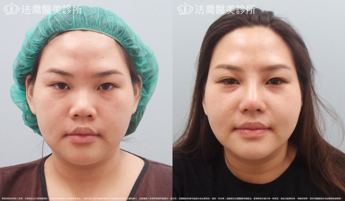 goretex隆鼻,法喬醫美診所,邱浚彥