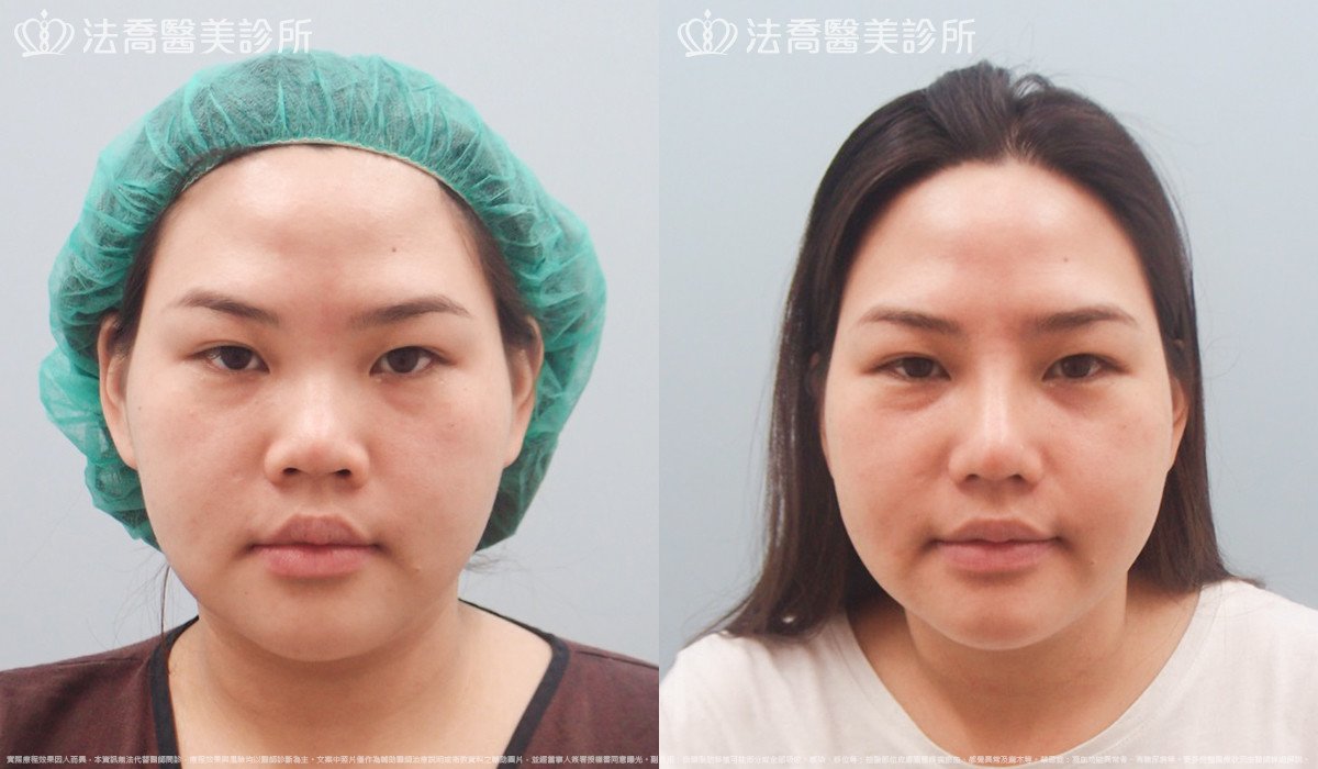 goretex隆鼻,法喬醫美診所,邱浚彥