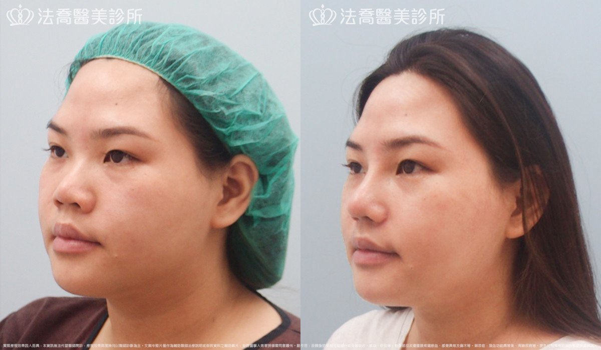 goretex隆鼻,法喬醫美診所,邱浚彥