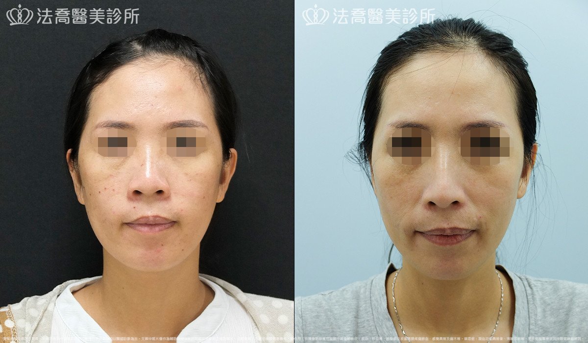 法喬醫美診所,邱浚彥,Goretex隆鼻 