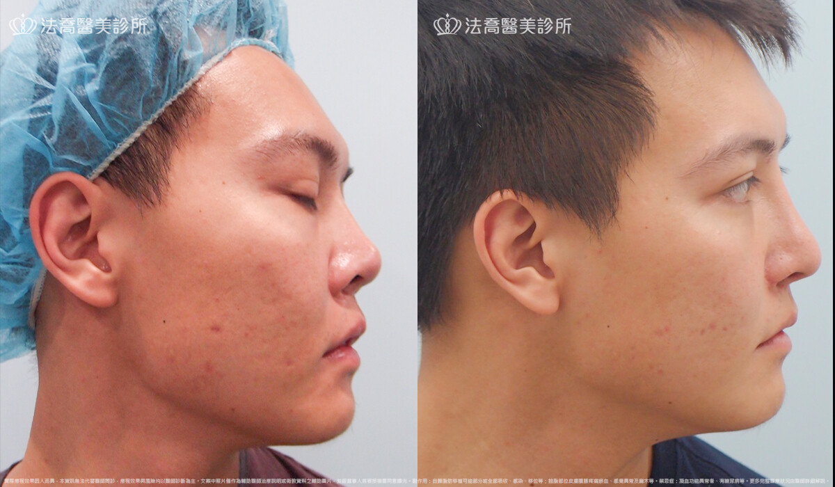 goretex隆鼻,法喬醫美診所,邱浚彥