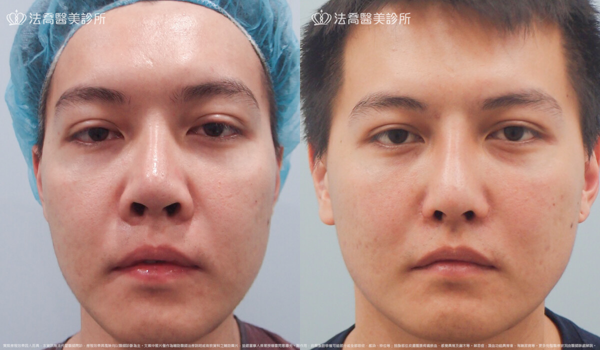 goretex隆鼻,法喬醫美診所,邱浚彥