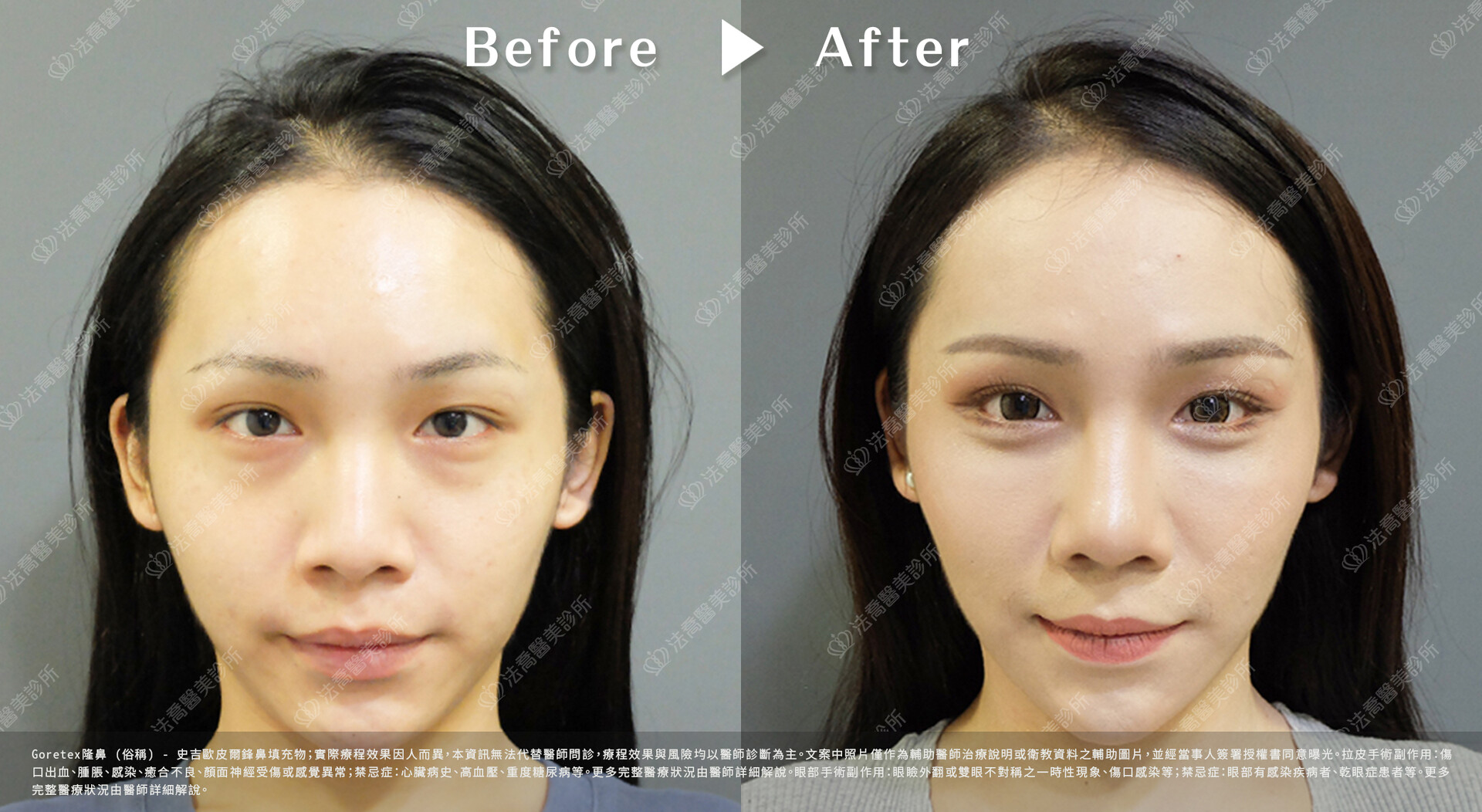 goretex隆鼻,法喬醫美診所,邱浚彥