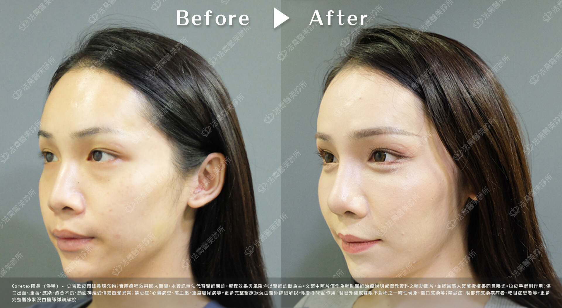 goretex隆鼻,法喬醫美診所,邱浚彥
