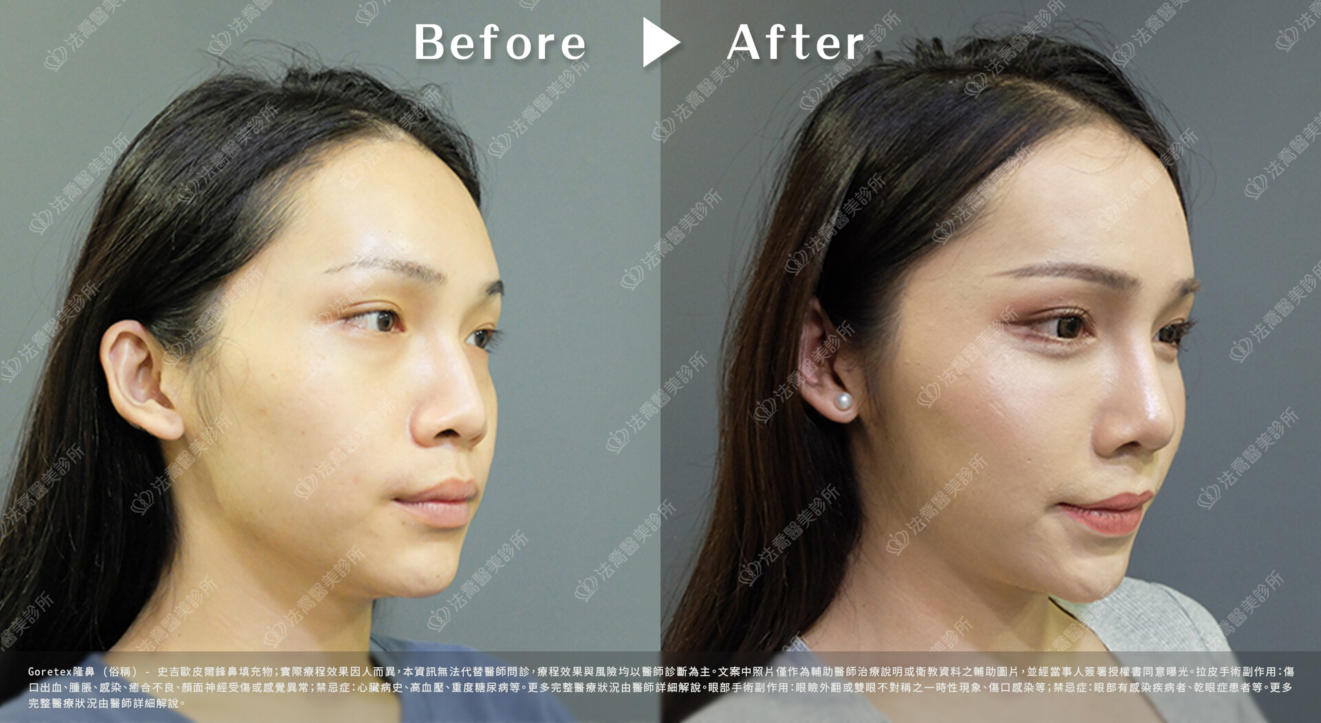 goretex隆鼻,法喬醫美診所,邱浚彥
