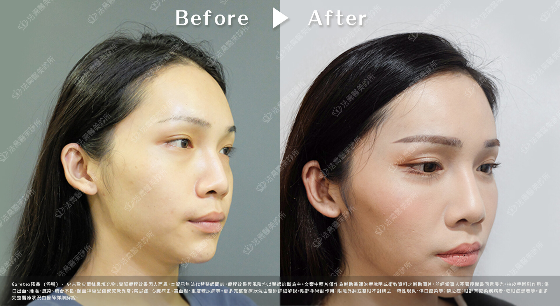 goretex隆鼻,法喬醫美診所,邱浚彥