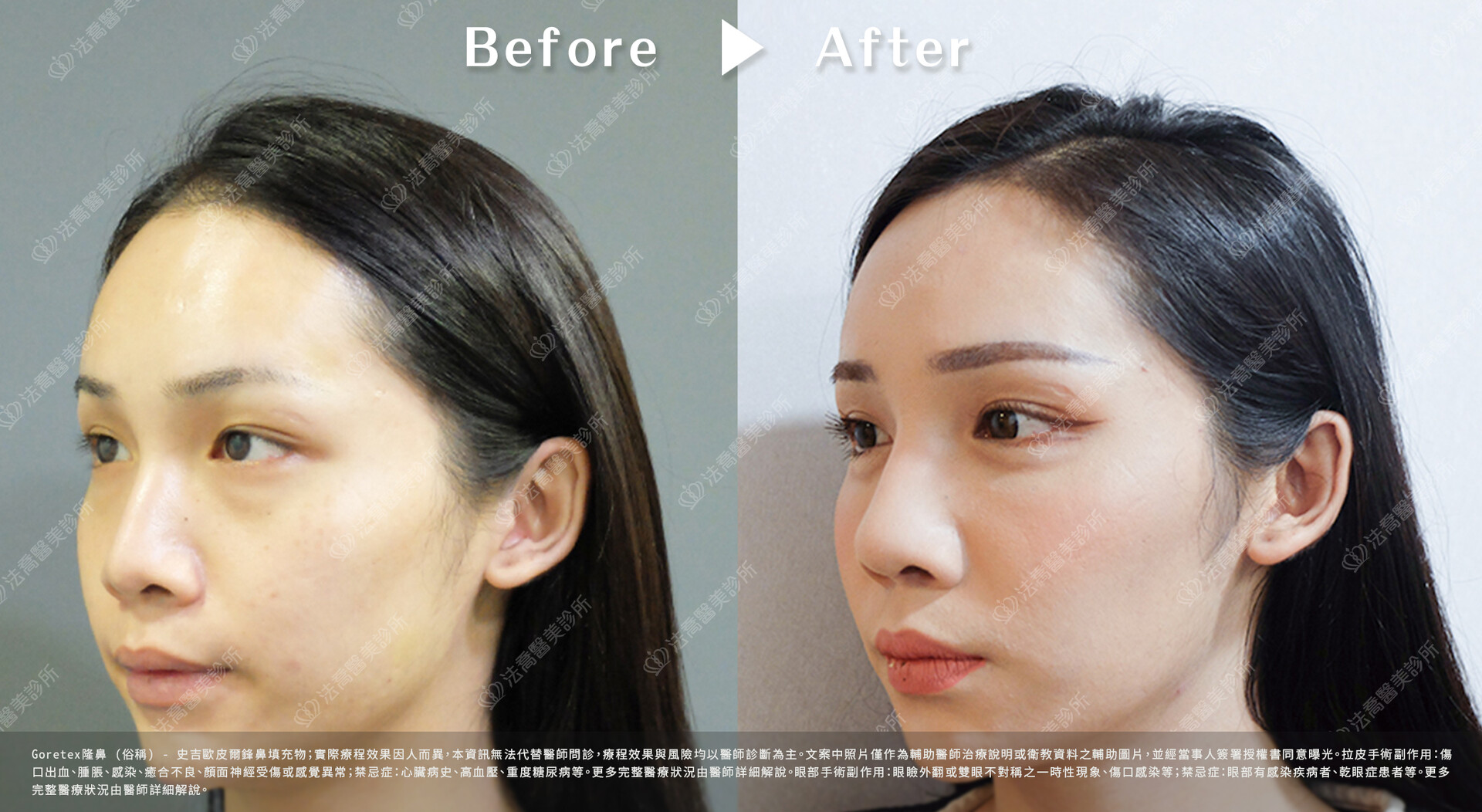 goretex隆鼻,法喬醫美診所,邱浚彥