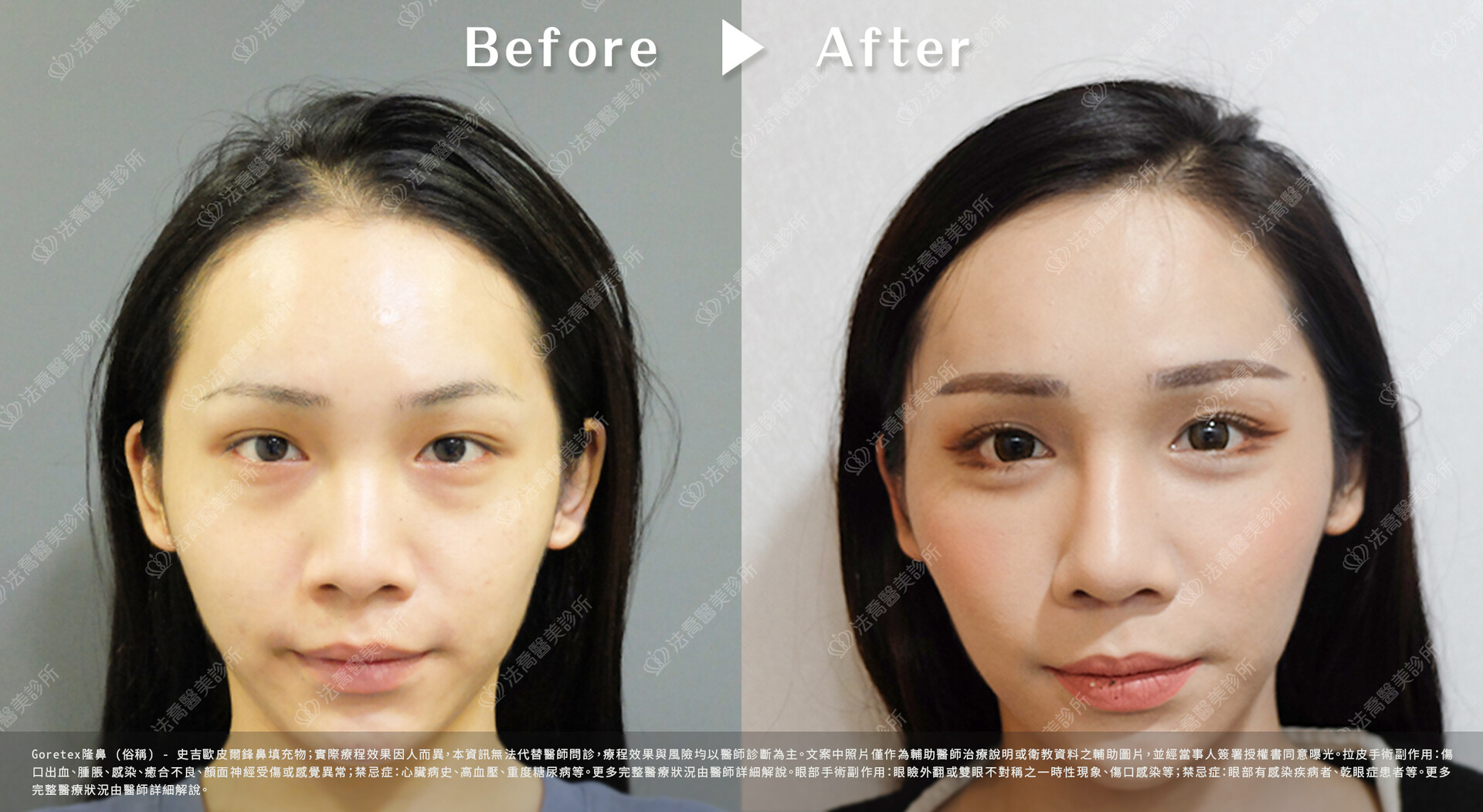 goretex隆鼻,法喬醫美診所,邱浚彥