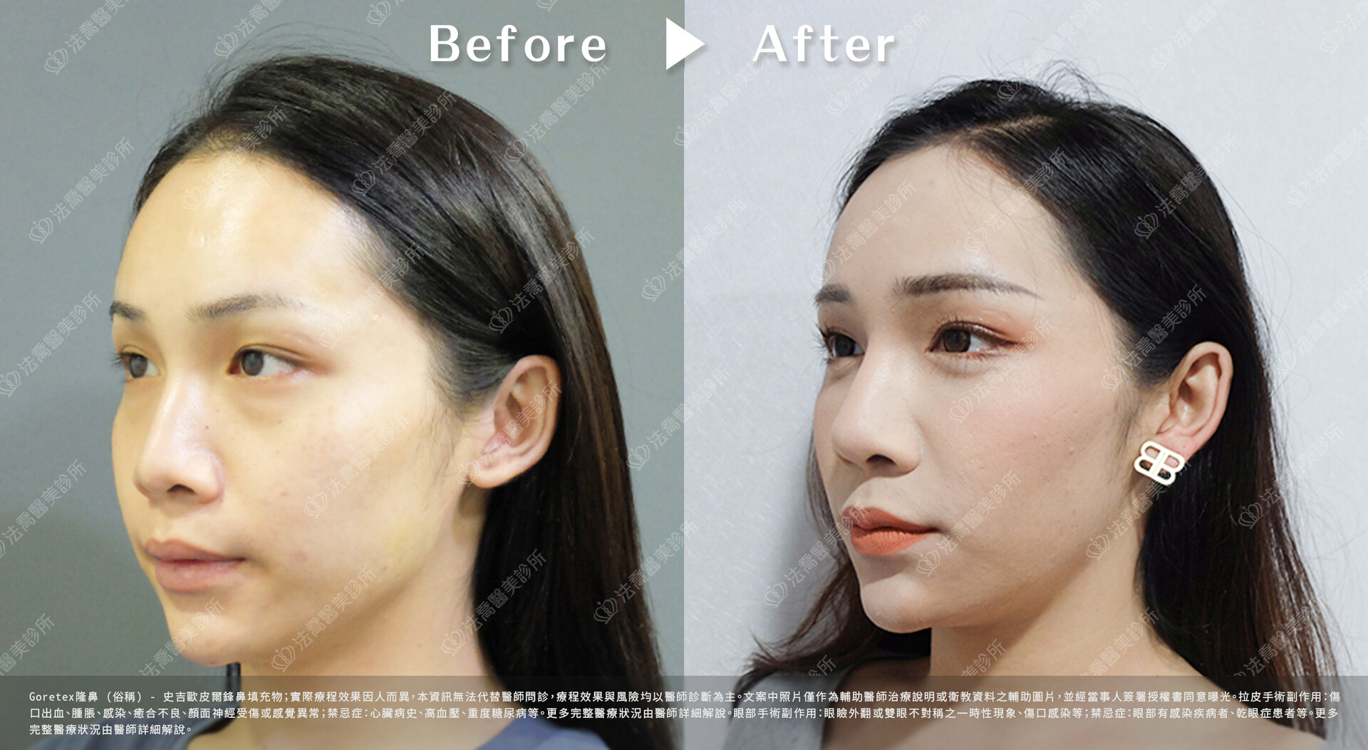 goretex隆鼻,法喬醫美診所,邱浚彥