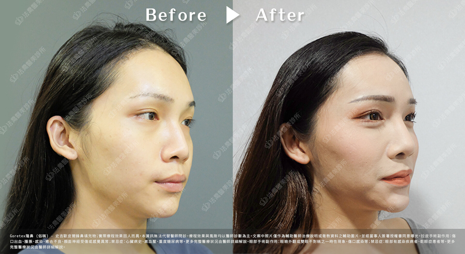 goretex隆鼻,法喬醫美診所,邱浚彥