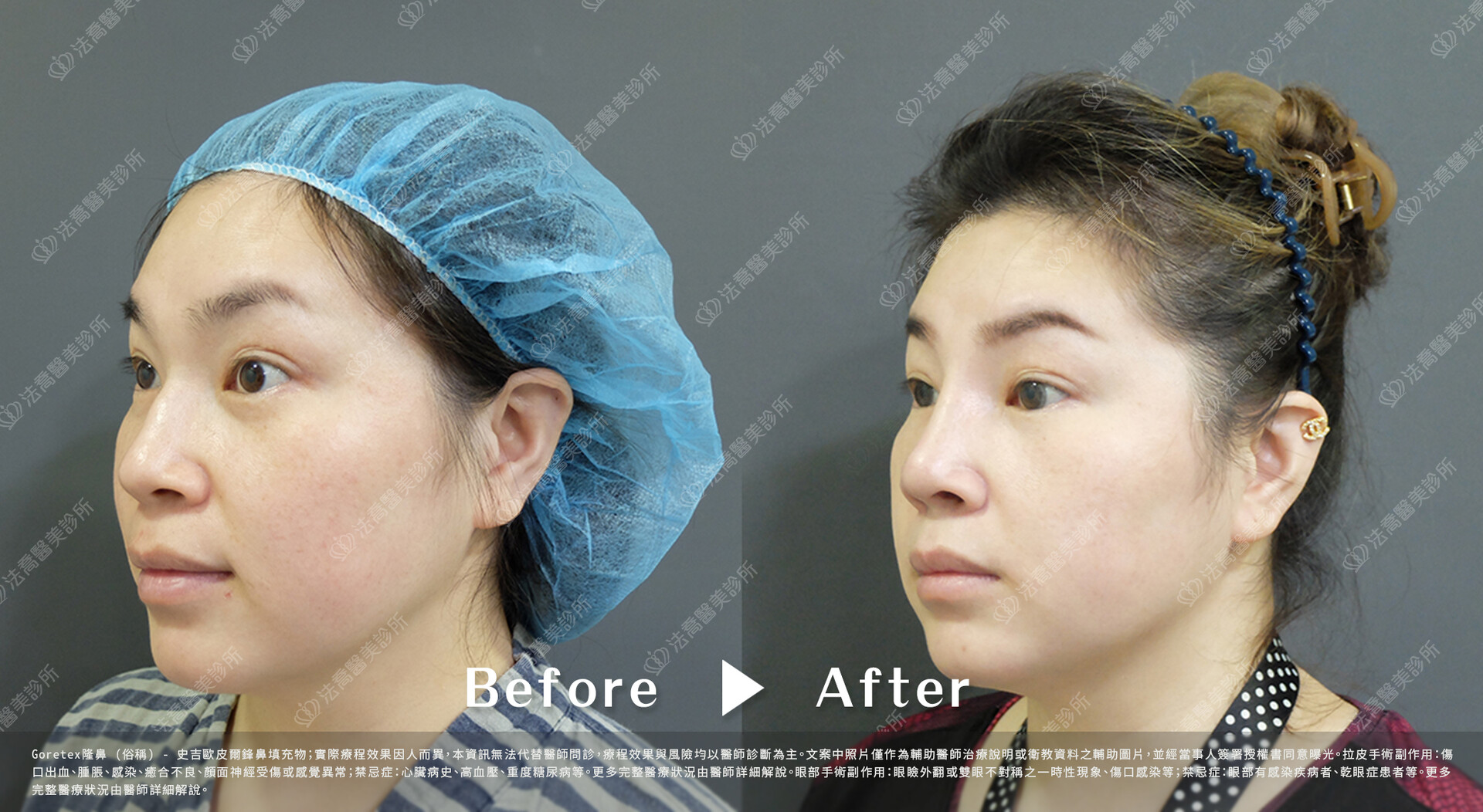 goretex隆鼻,法喬醫美診所,邱浚彥