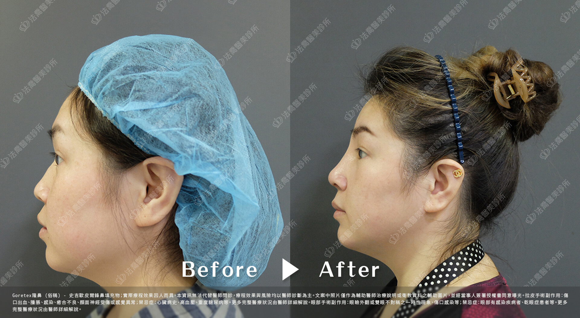 goretex隆鼻,法喬醫美診所,邱浚彥