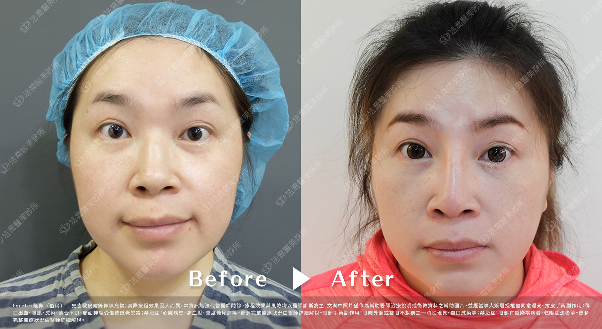 goretex隆鼻,法喬醫美診所,邱浚彥