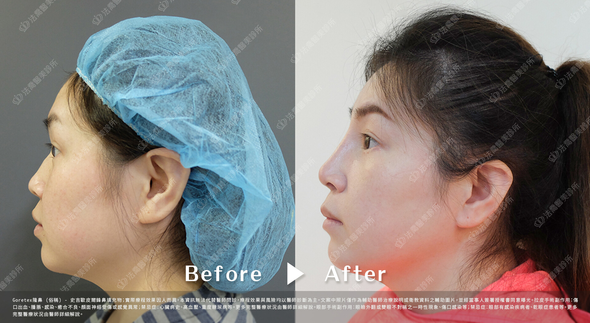 goretex隆鼻,法喬醫美診所,邱浚彥