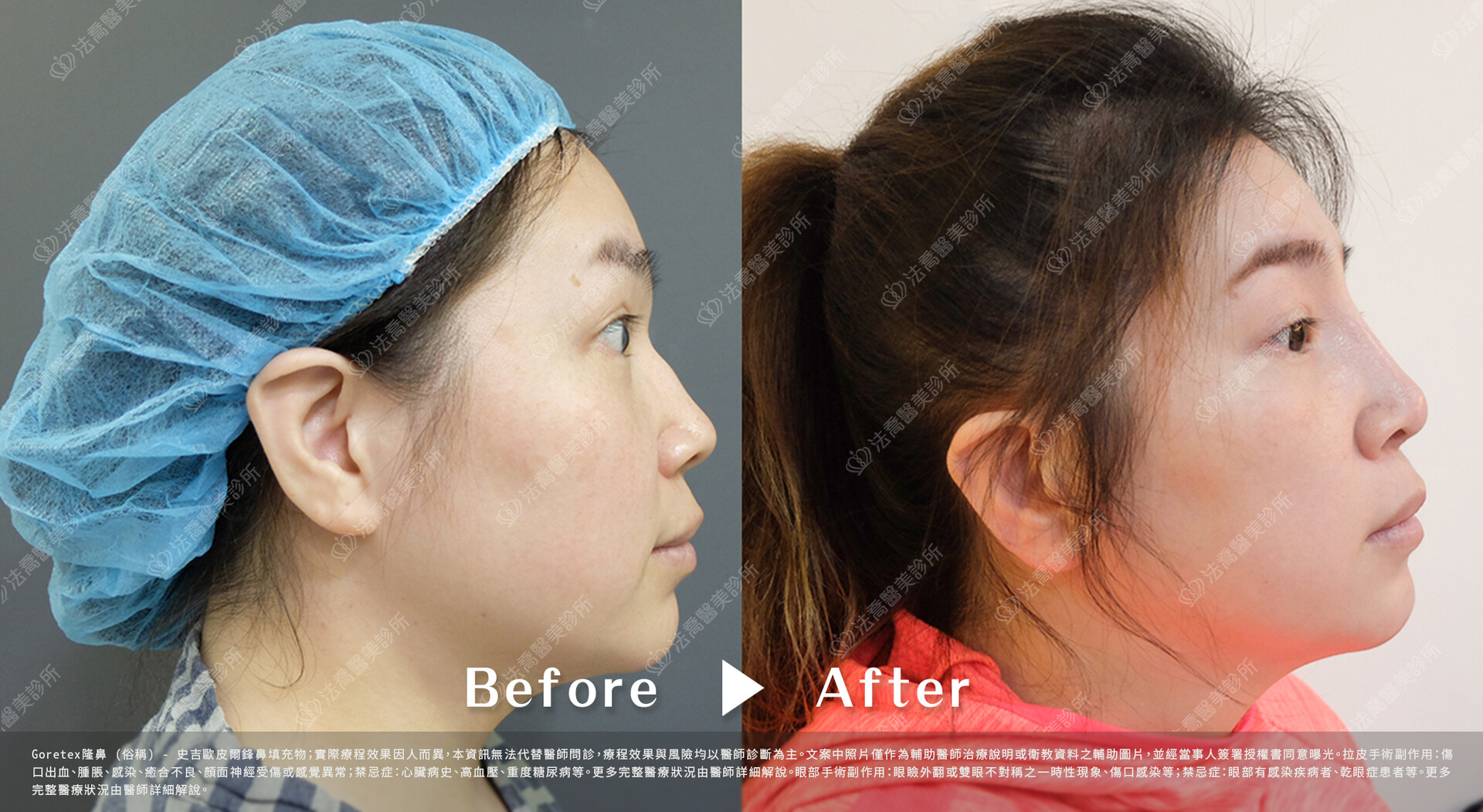 goretex隆鼻,法喬醫美診所,邱浚彥