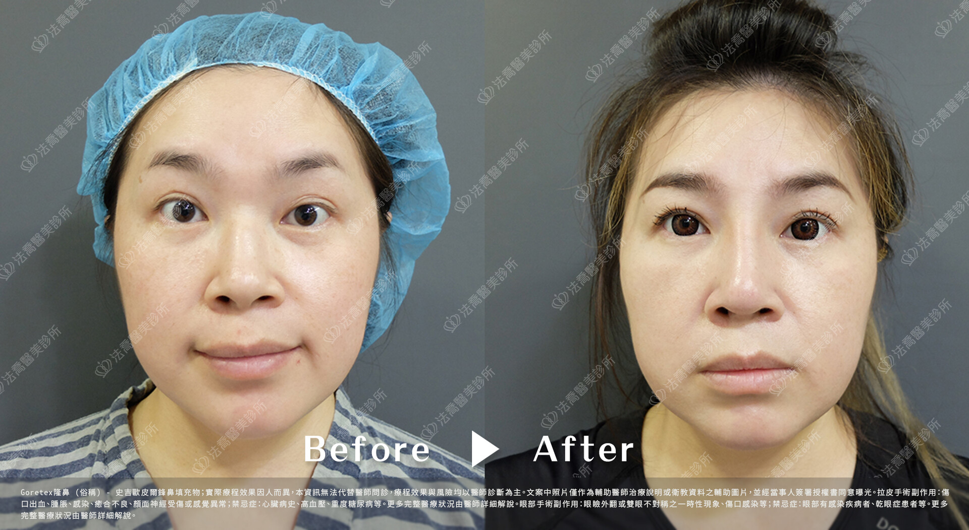 goretex隆鼻,法喬醫美診所,邱浚彥