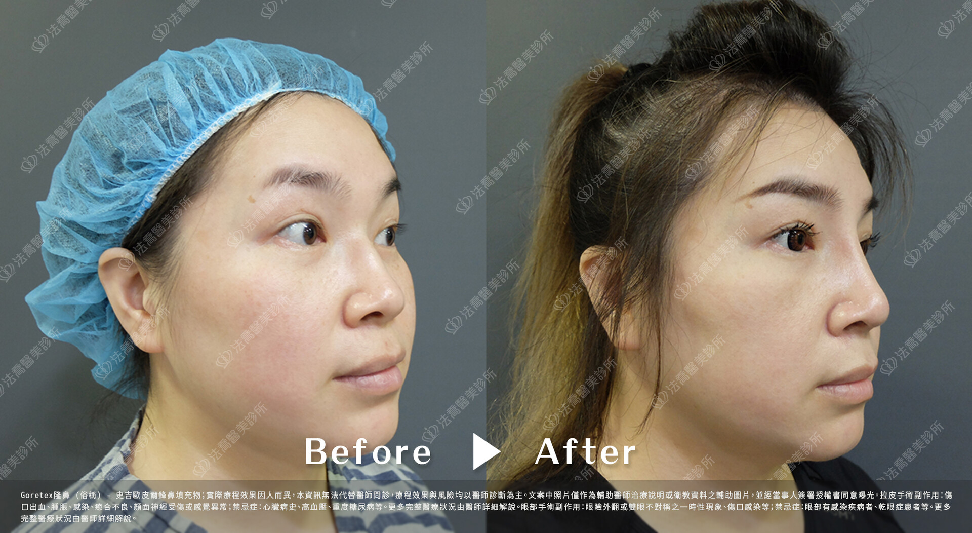 goretex隆鼻,法喬醫美診所,邱浚彥
