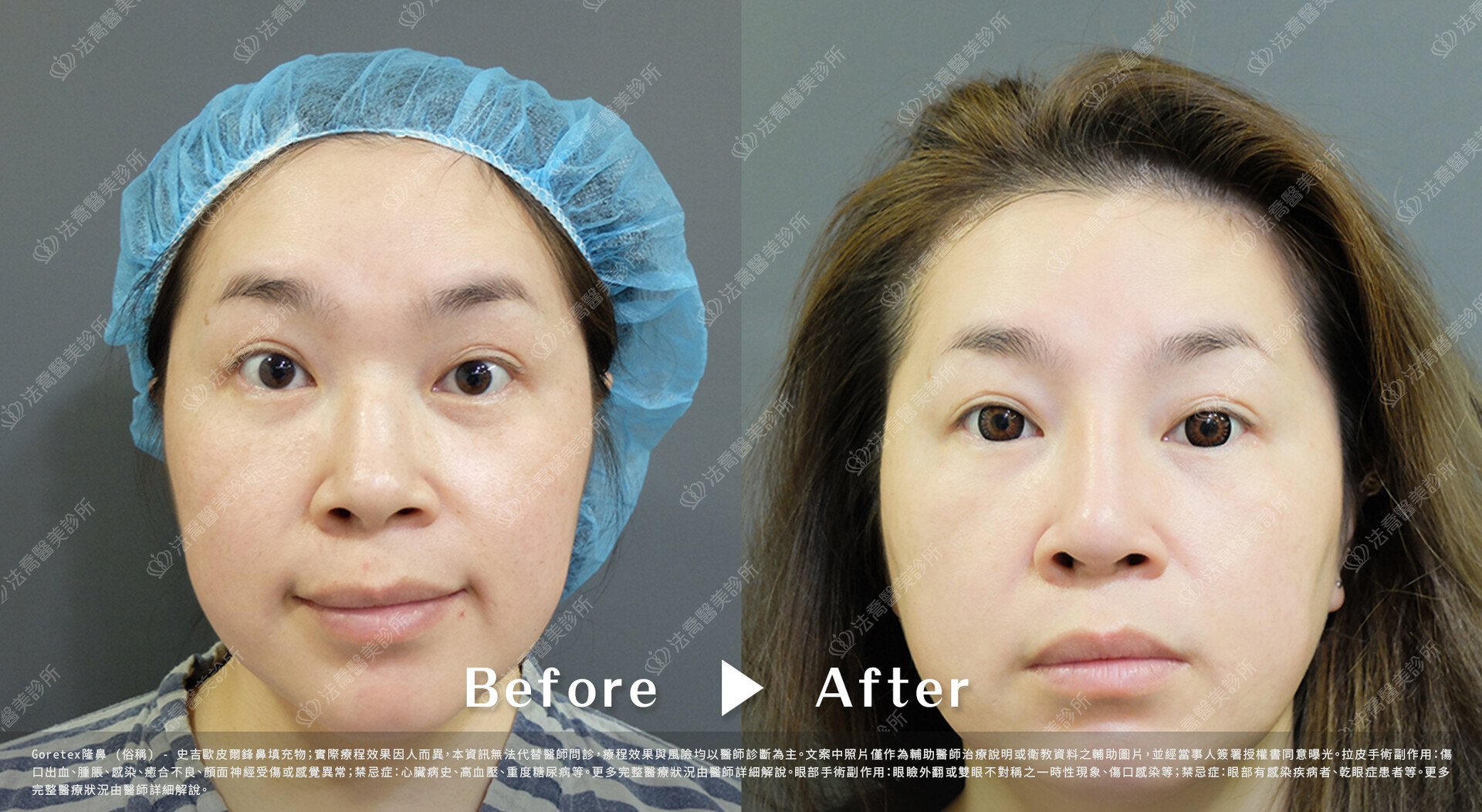 goretex隆鼻,法喬醫美診所,邱浚彥