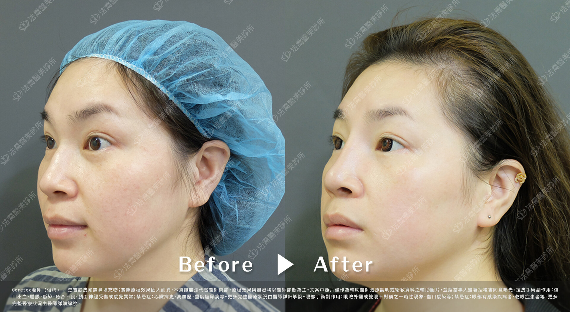 goretex隆鼻,法喬醫美診所,邱浚彥