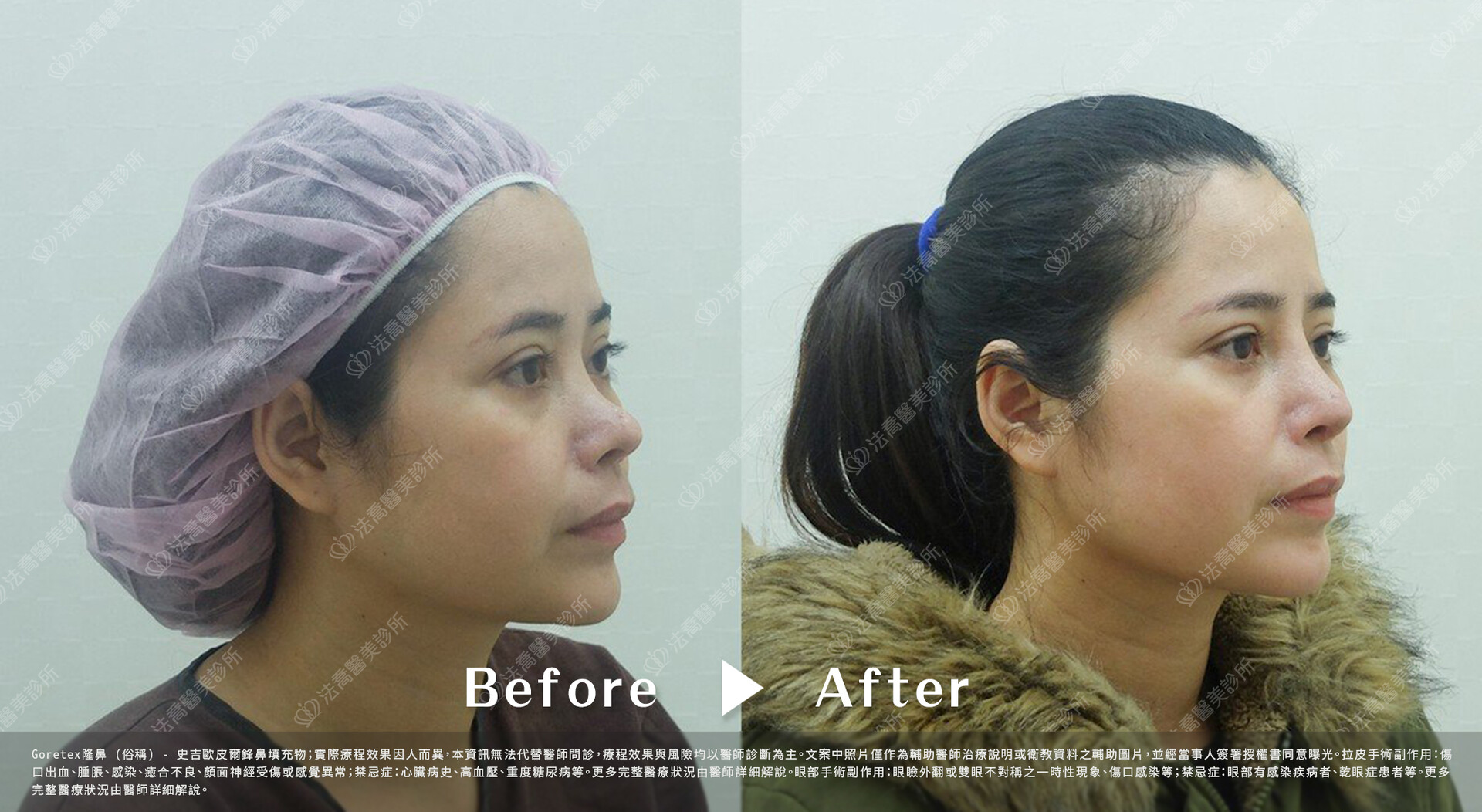 goretex隆鼻,法喬醫美診所,邱浚彥