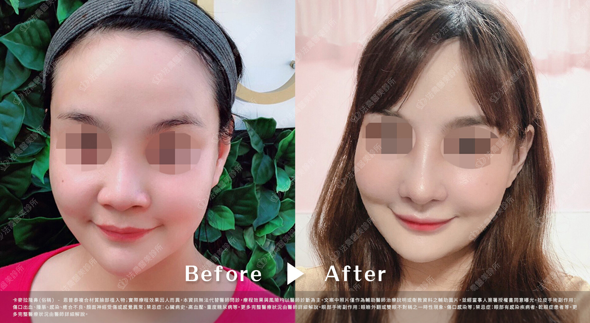 法喬醫美診所,邱浚彥,隆鼻