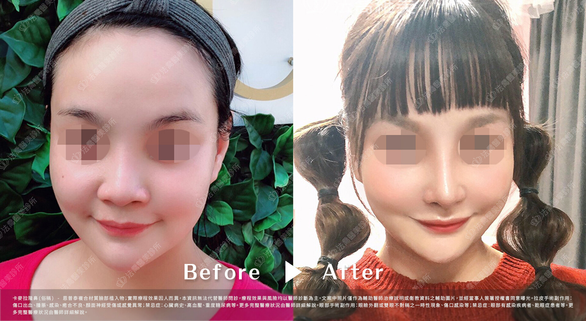 法喬醫美診所,邱浚彥,隆鼻
