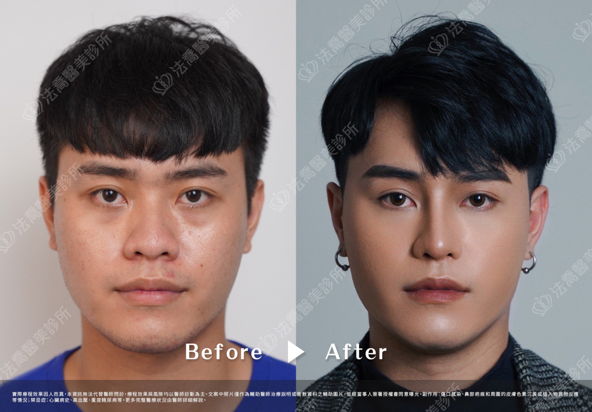 法喬綜合隆鼻案例