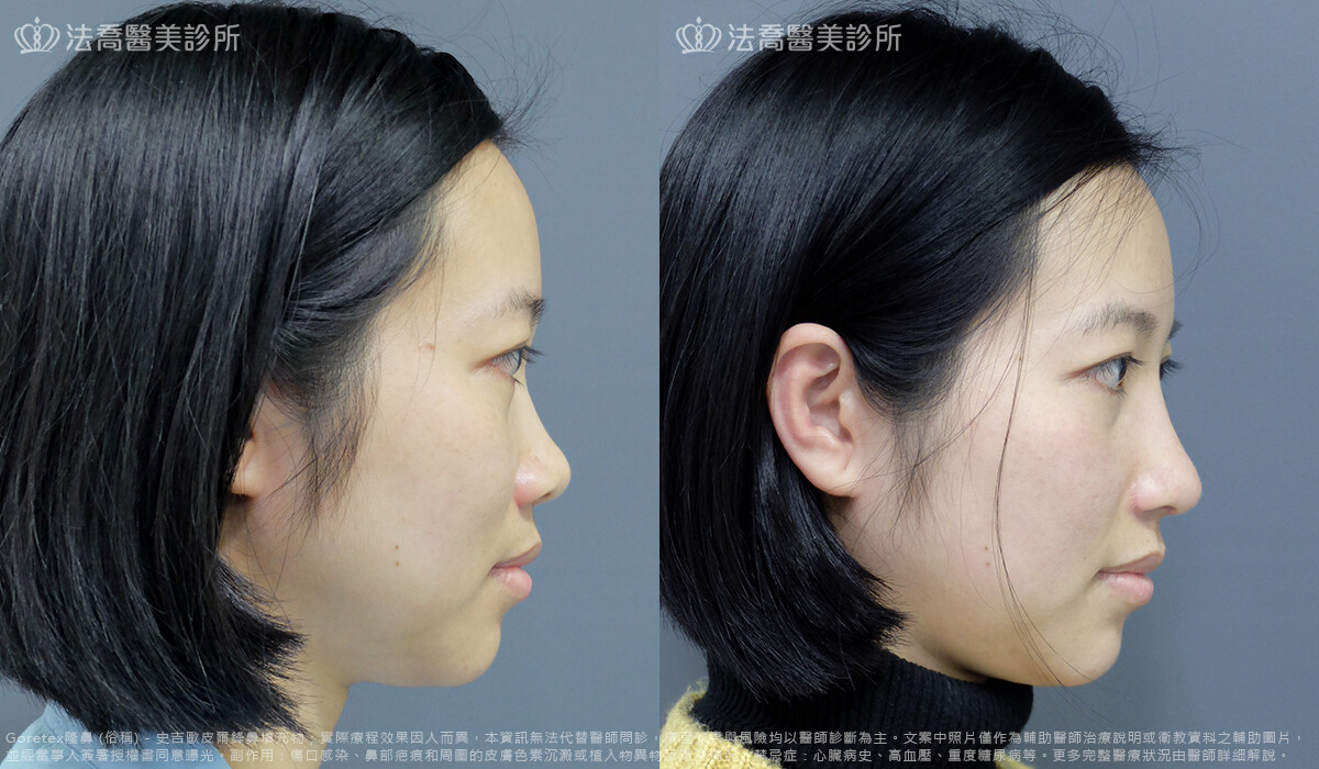 鼻翼手術