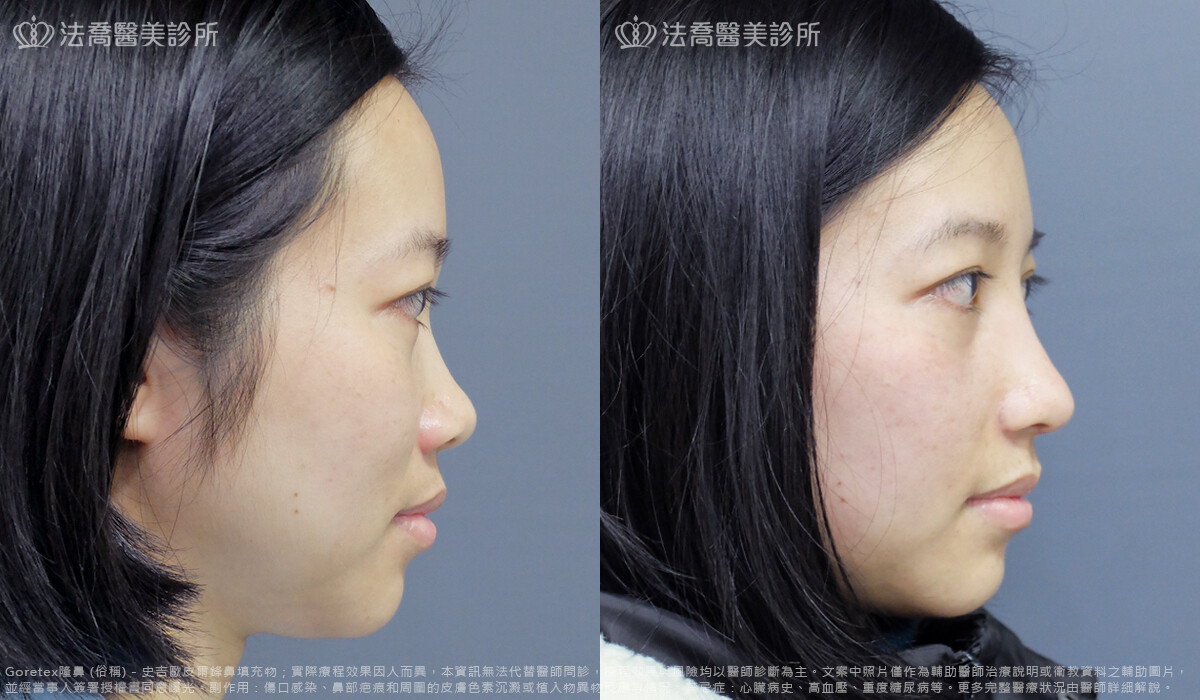 鼻截骨