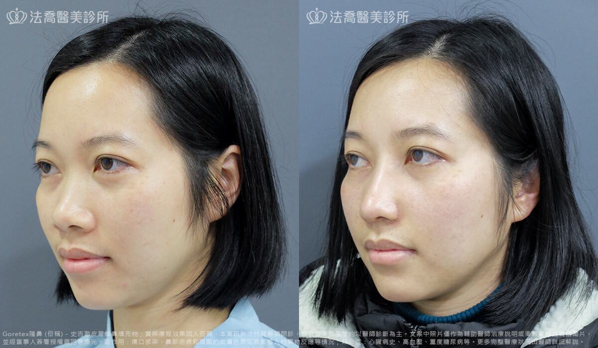 隆鼻推薦
