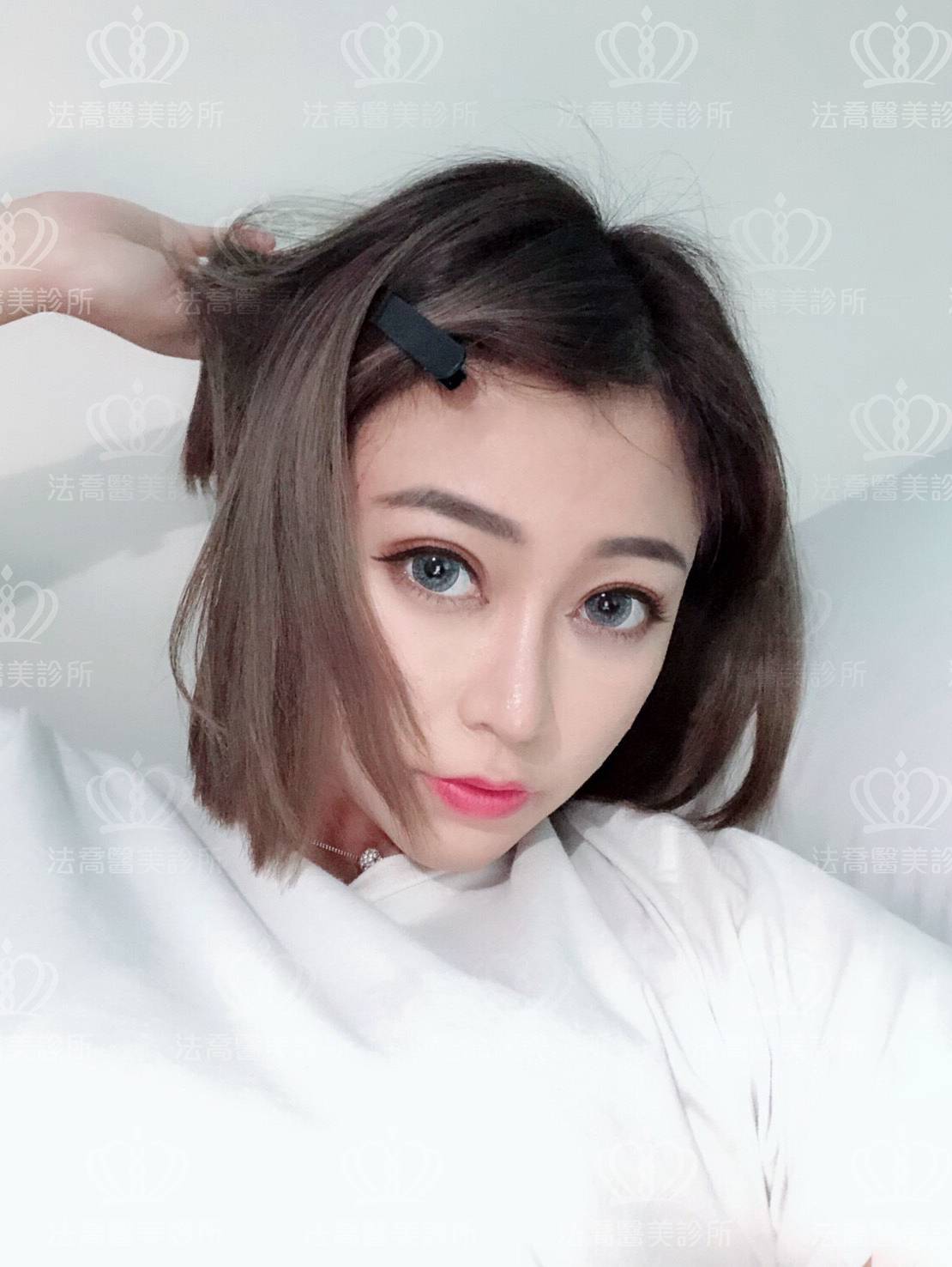 法喬醫美-Goretex隆鼻案例