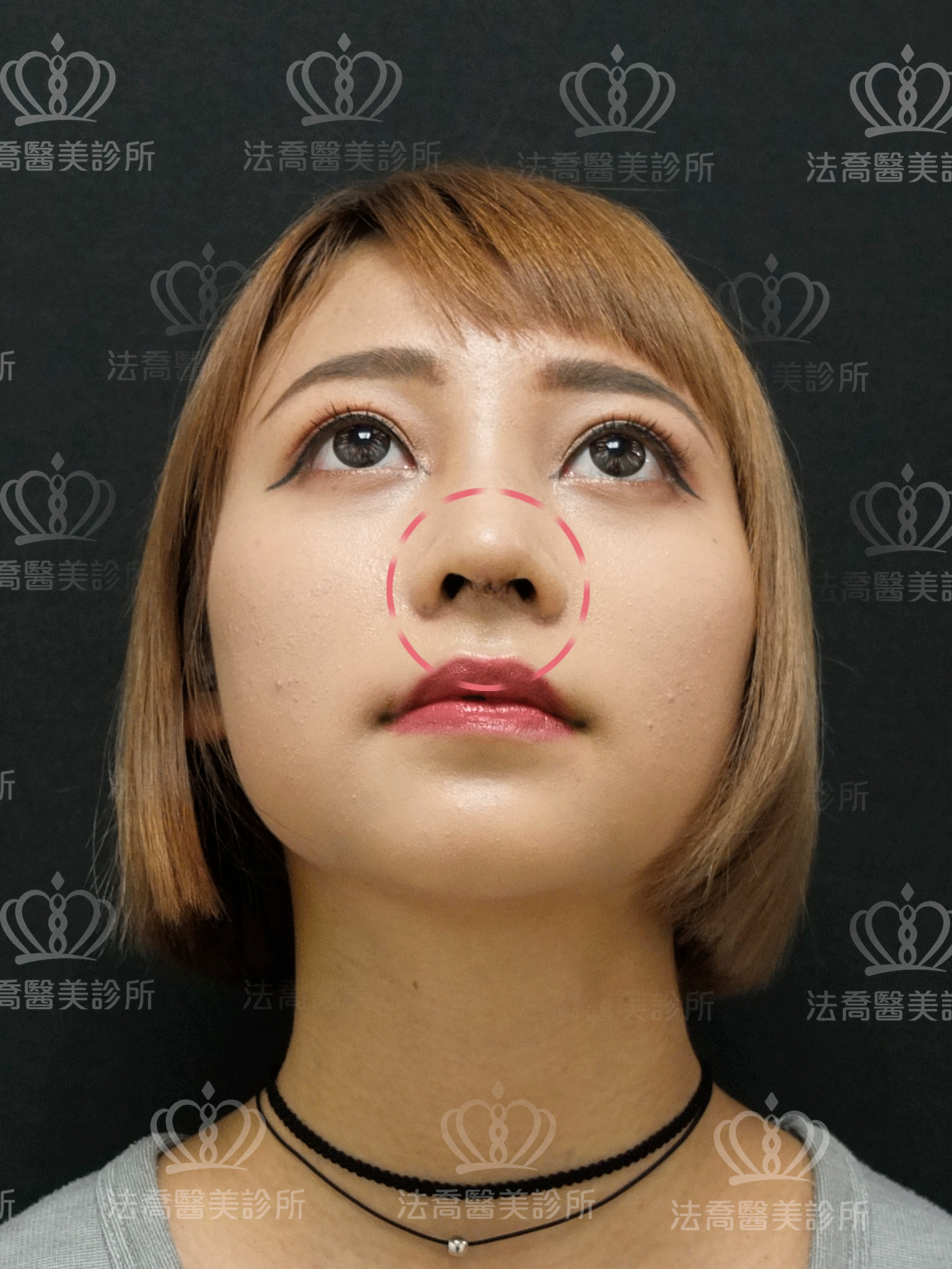 法喬醫美診所-Goretex案例