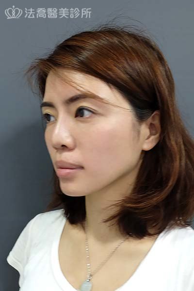 自體肋骨隆鼻