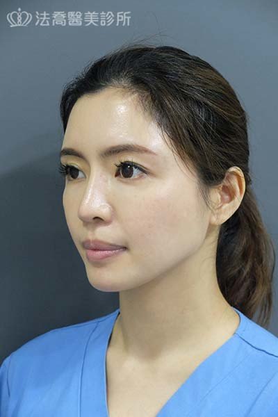 自體肋骨隆鼻