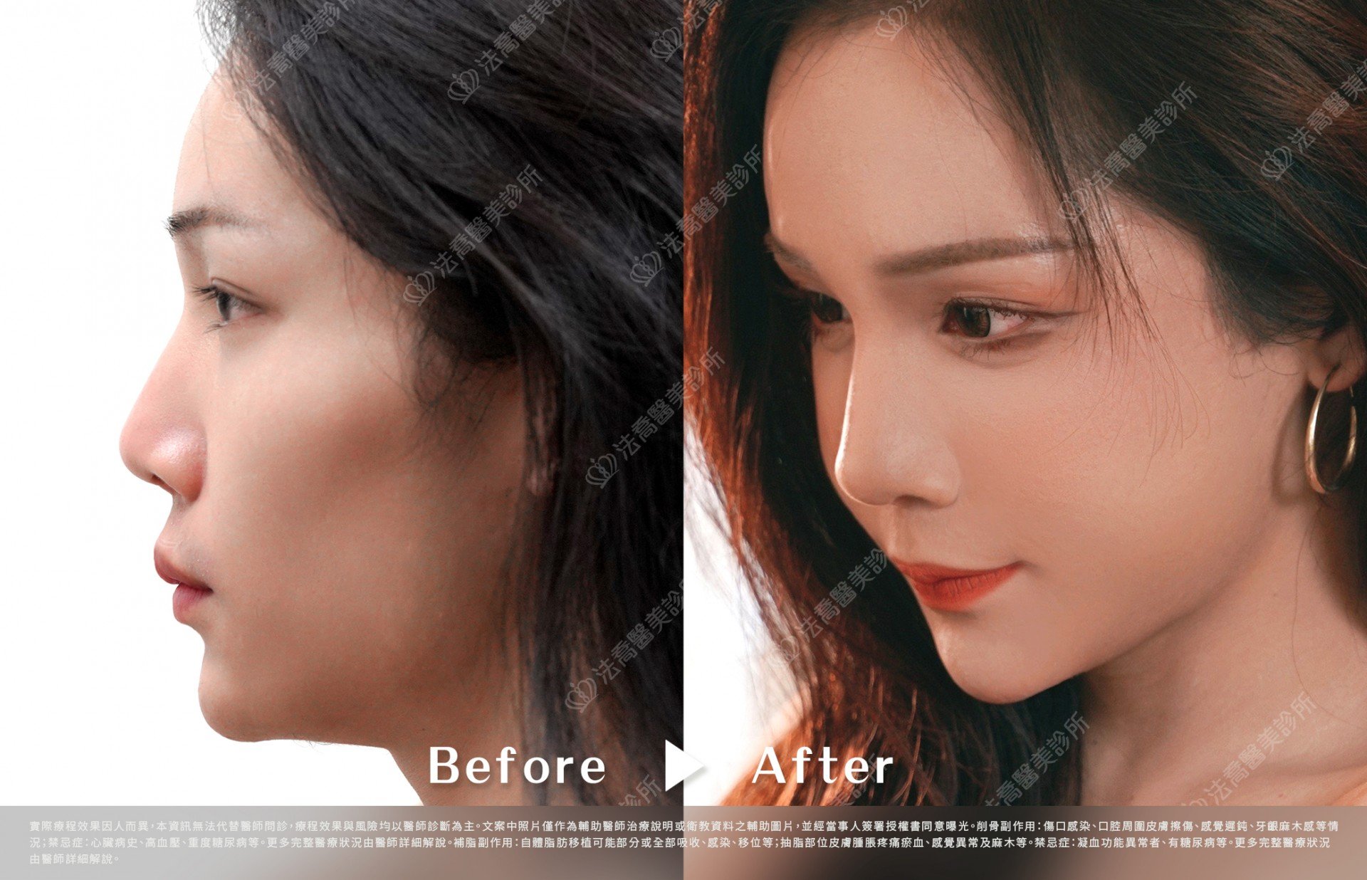 術前與術後3個月(側面)