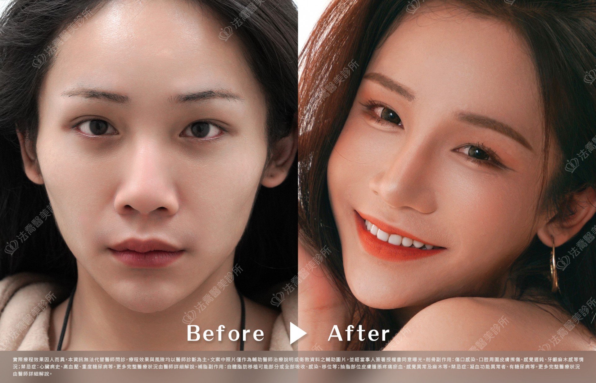 術前與術後3個月(正面)