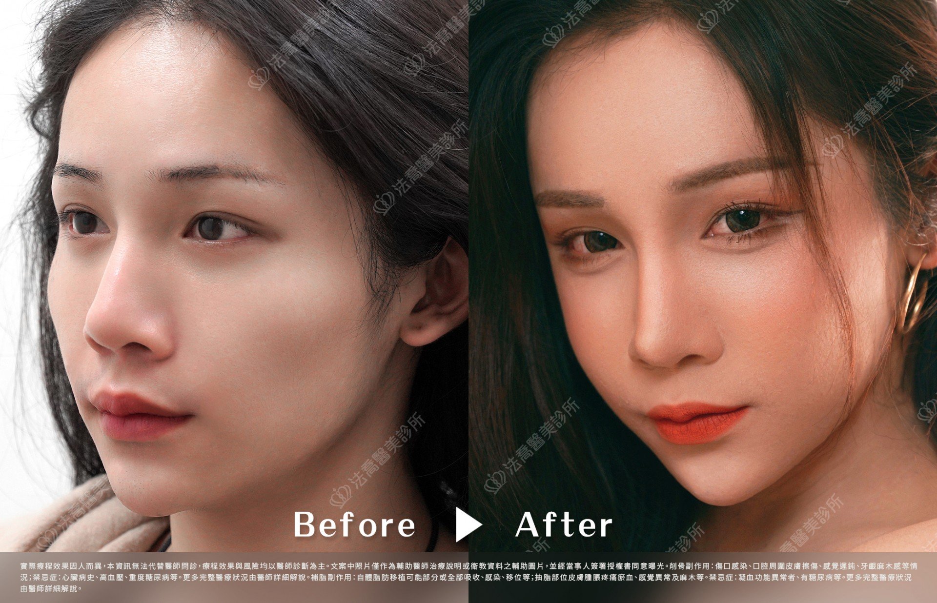 術前與術後3個月(側45度)