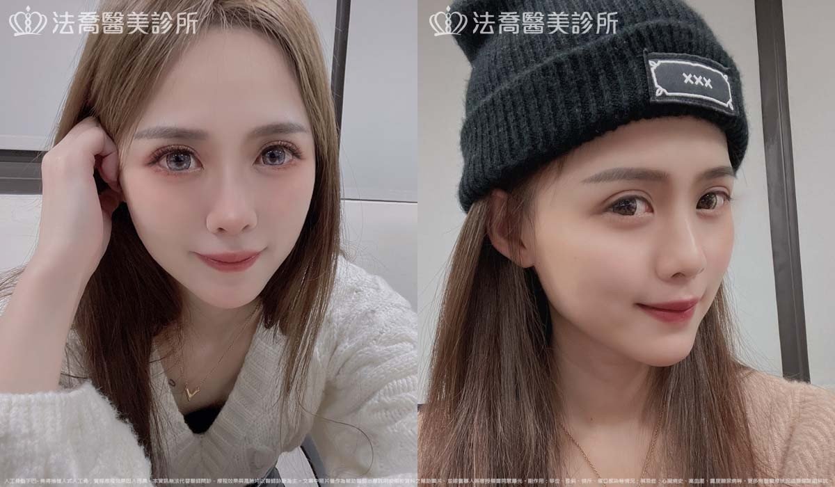 法喬醫美診所,邱浚彥,墊下巴