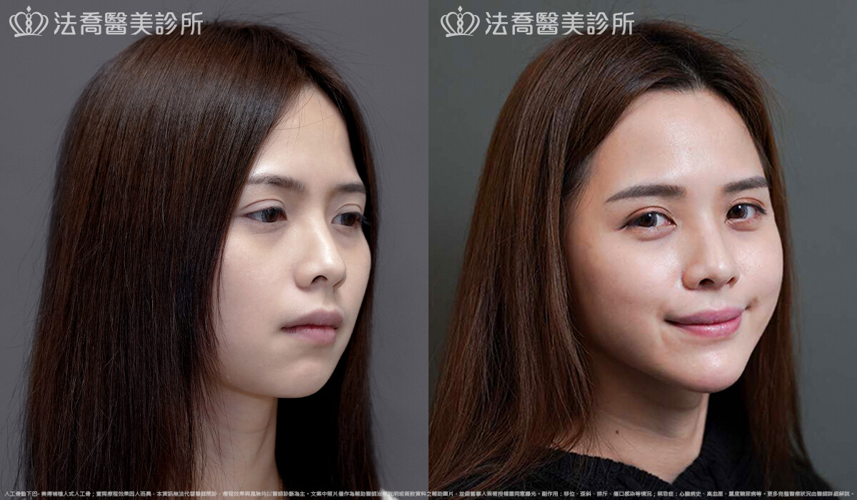 法喬醫美診所,邱浚彥,墊下巴