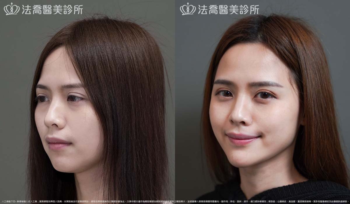 法喬醫美診所,邱浚彥,墊下巴