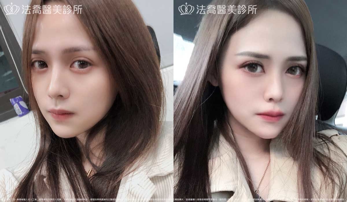 法喬醫美診所,邱浚彥,墊下巴