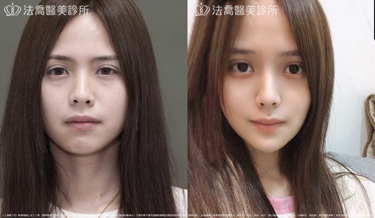 法喬醫美診所,邱浚彥,墊下巴