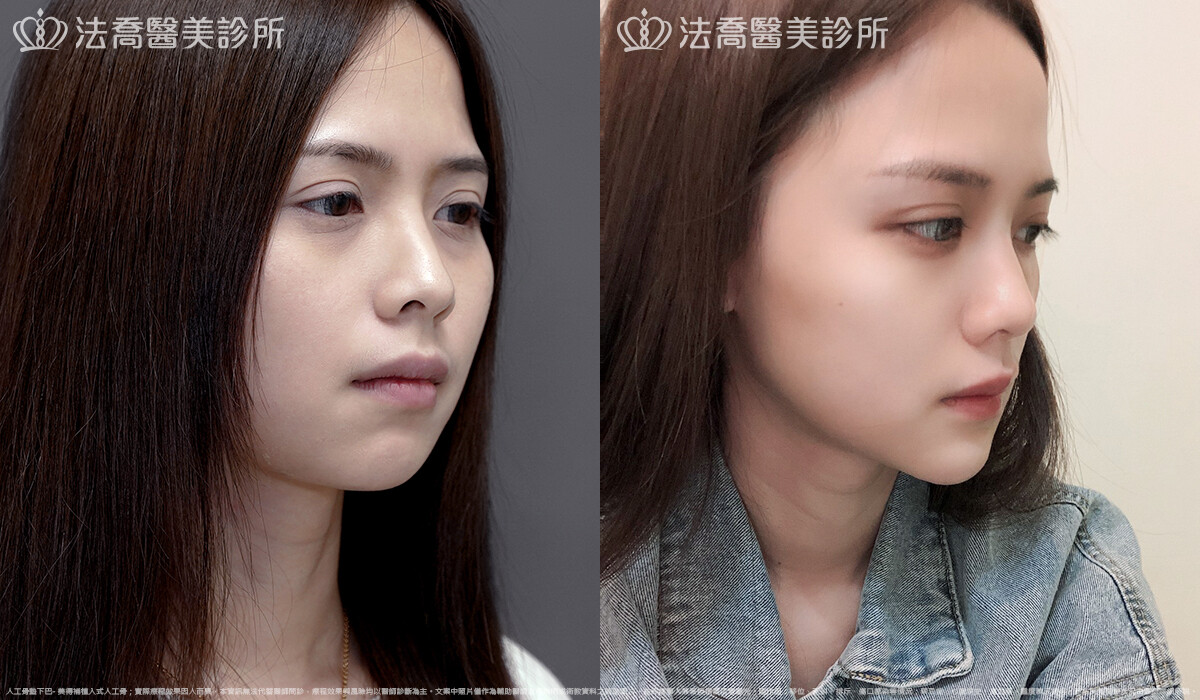 法喬醫美診所,邱浚彥,墊下巴