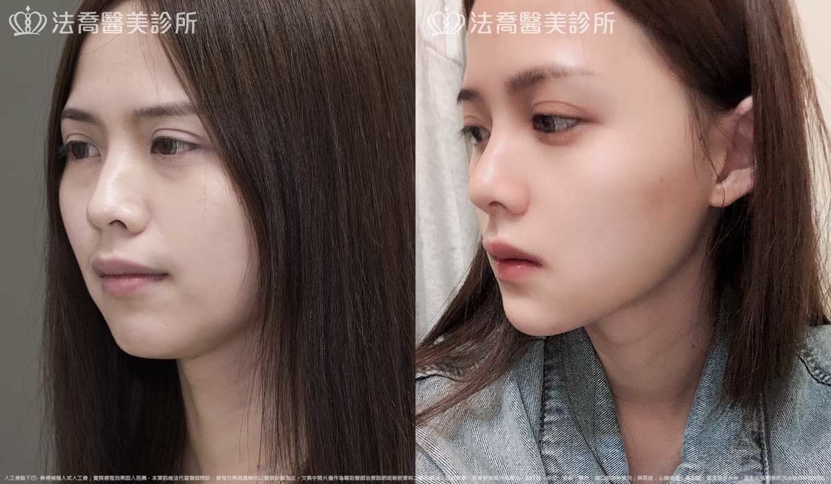 法喬醫美診所,邱浚彥,墊下巴