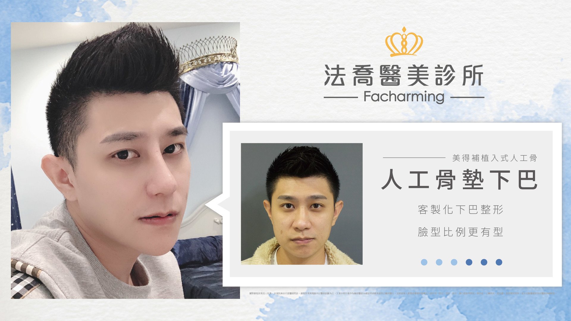 法喬醫美診所-自體肋骨隆鼻+縮鼻翼