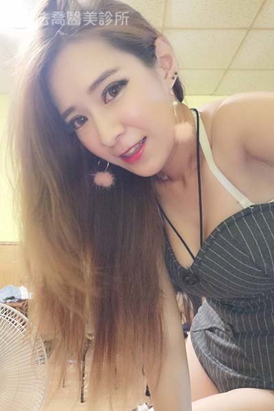 自體肋骨隆鼻