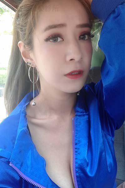 自體肋骨隆鼻