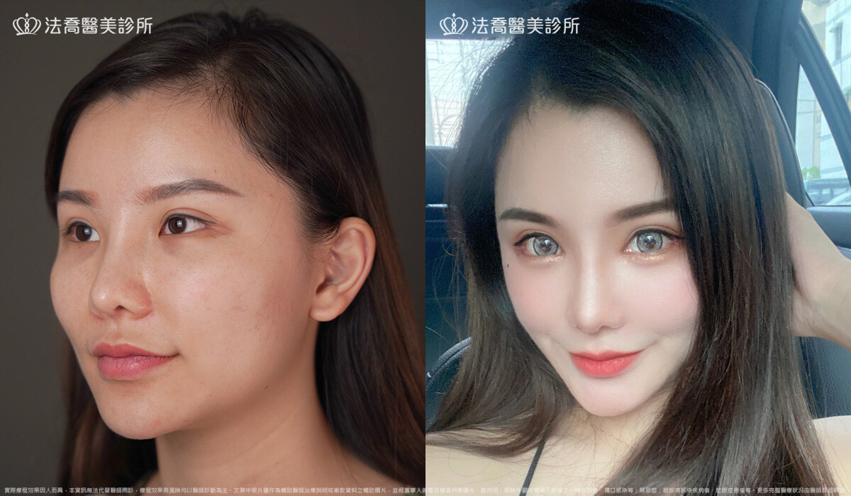 鼻截骨
